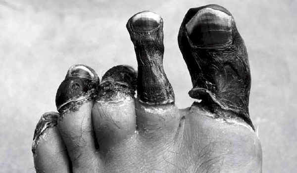 Frostbite 2.jpg (75494 bytes)